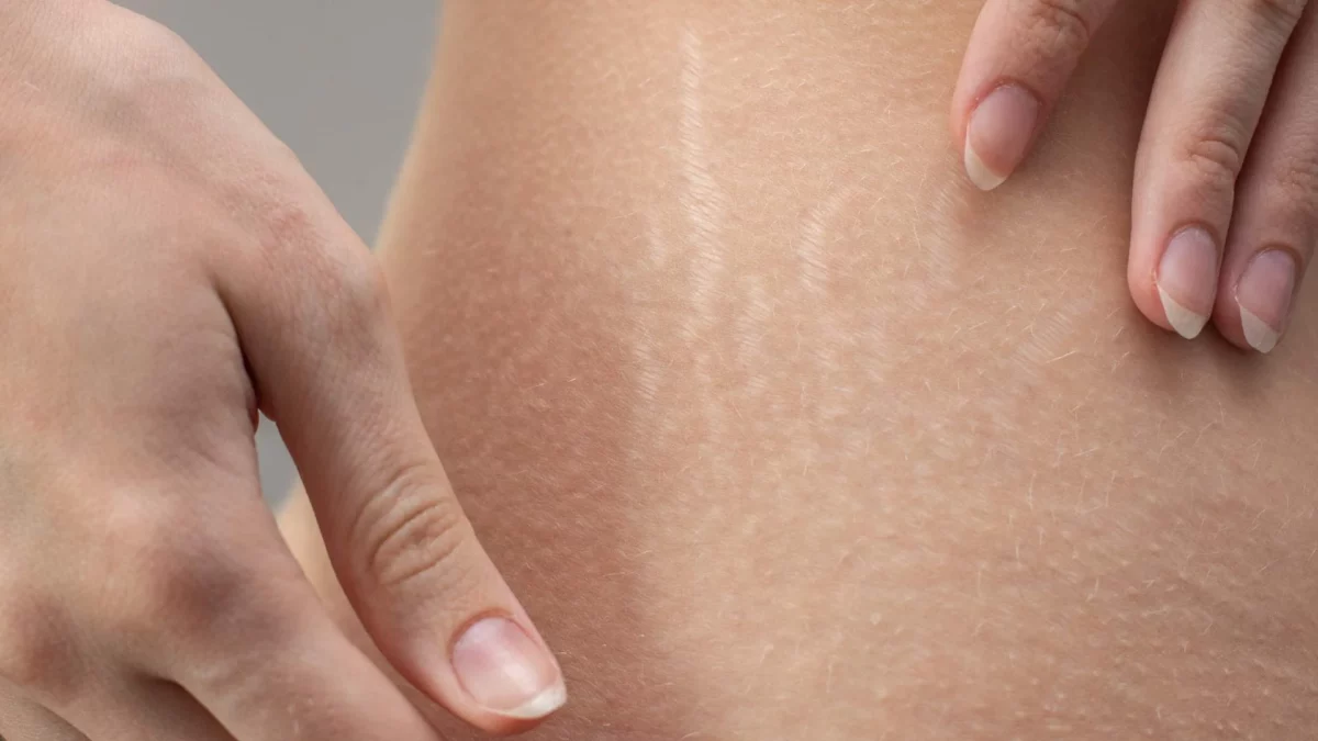 Co dělat se striemi na kůži? Tento domácí peeling sníží jejich vzhled